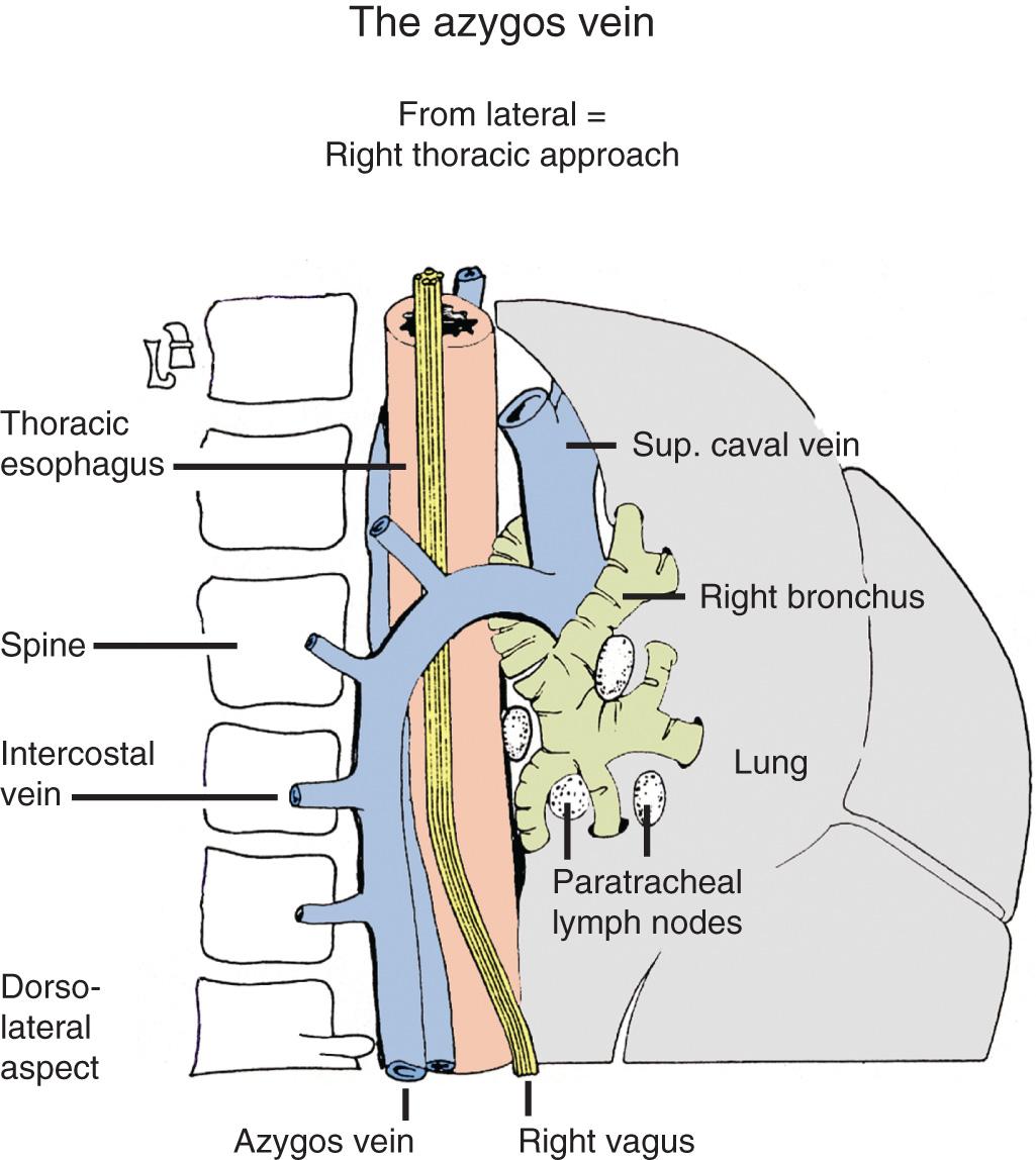 FIGURE 4.10, From a right thoracotomy approach, the azygos is to the right of the esophagus and can be divided to improve exposure of the esophagus.