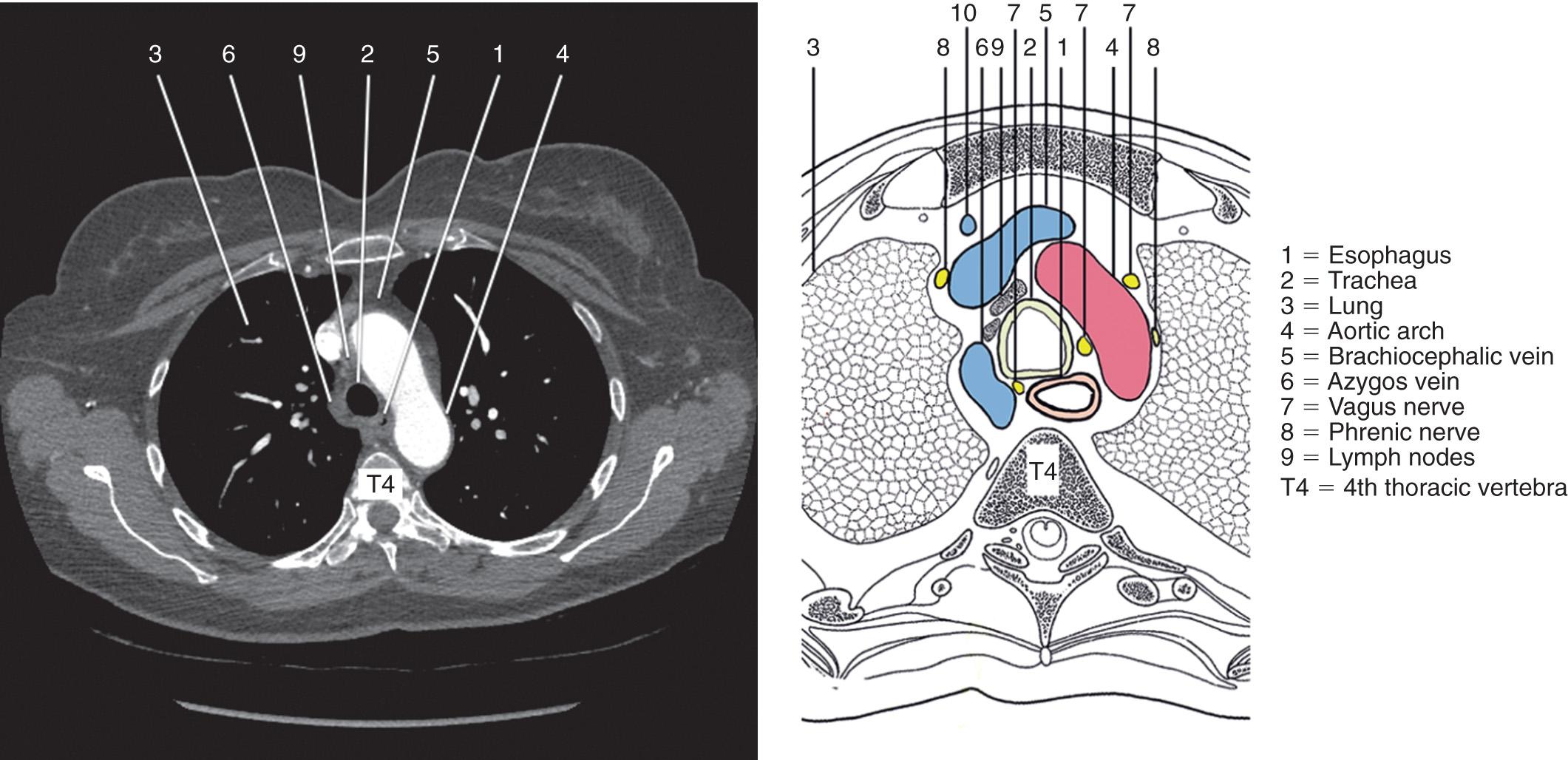 FIGURE 4.11, Topographic anatomy of the upper thoracic esophagus at the level of the aortic arch, along with a corresponding computed tomography image.