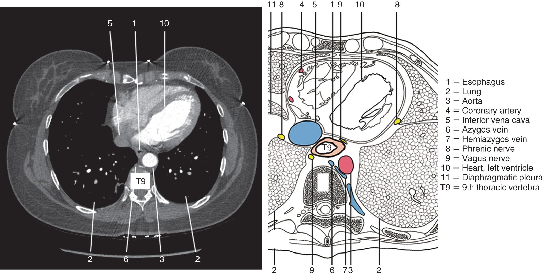 FIGURE 4.12, Topographic anatomy of the lower thoracic esophagus at the level of the left atrium, along with a corresponding computed tomography image.