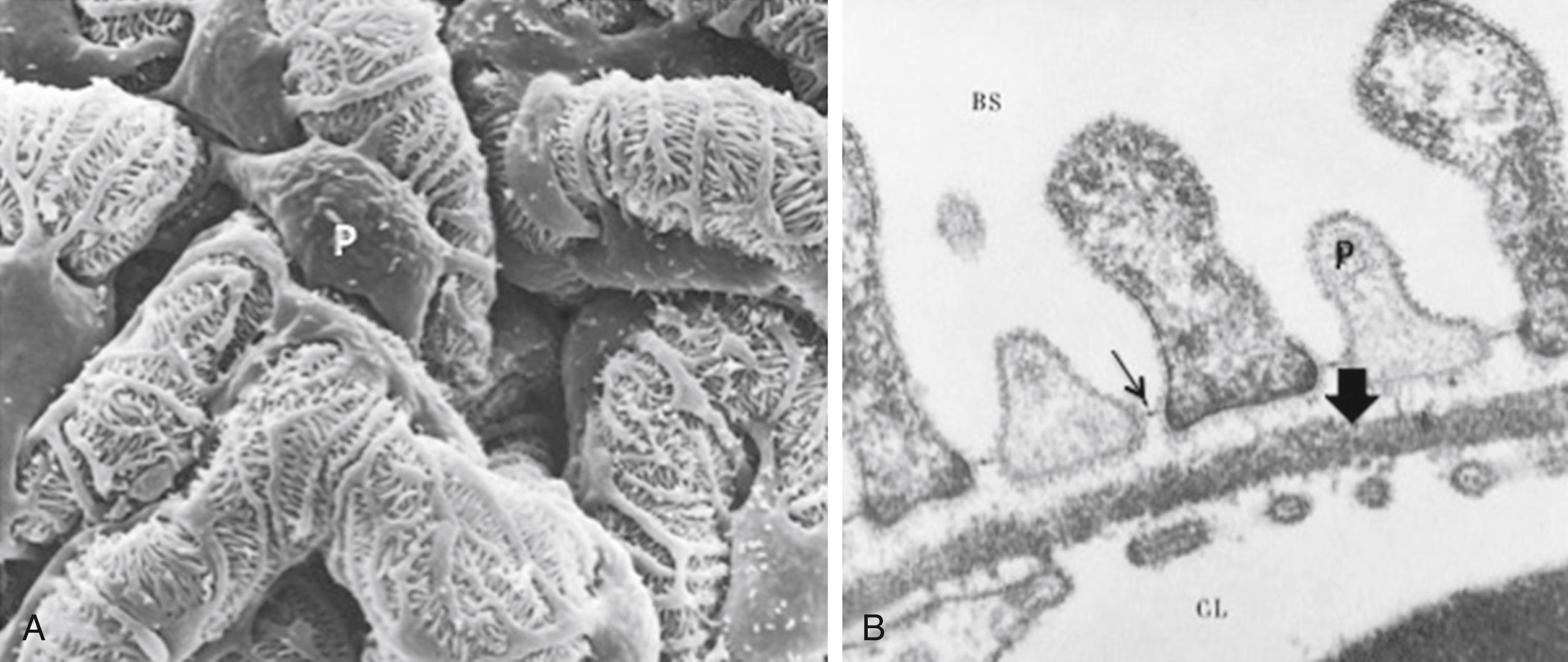 Fig. 17.5, (A) Scanning electron micrograph of podocytes (P) and their processes. (B) Electron micrograph of podocyte processes (P), the glomerular basement membrane, and glomerular capillaries. Slit diaphragms (arrow) span the podocyte processes. Large arrow points to the lamina densa of the glomerular basement membrane. BS , Bowman space; CL , glomerular capillary lumen.