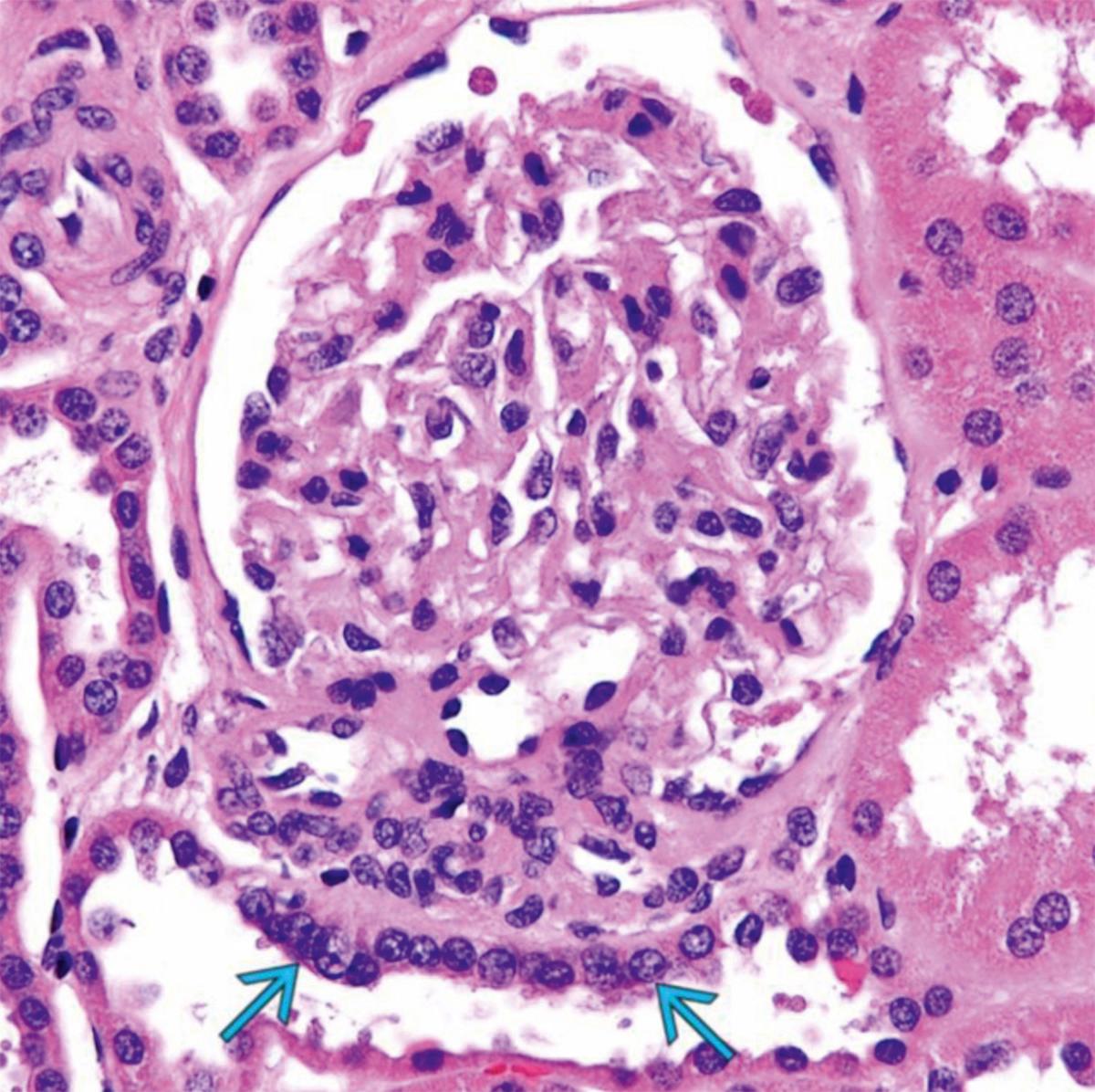 Fig. 17.7, The macula densa (arrows) . The cells of the macula densa represent a special portion of the distal tubule that is adjacent to the juxtaglomerular apparatus.