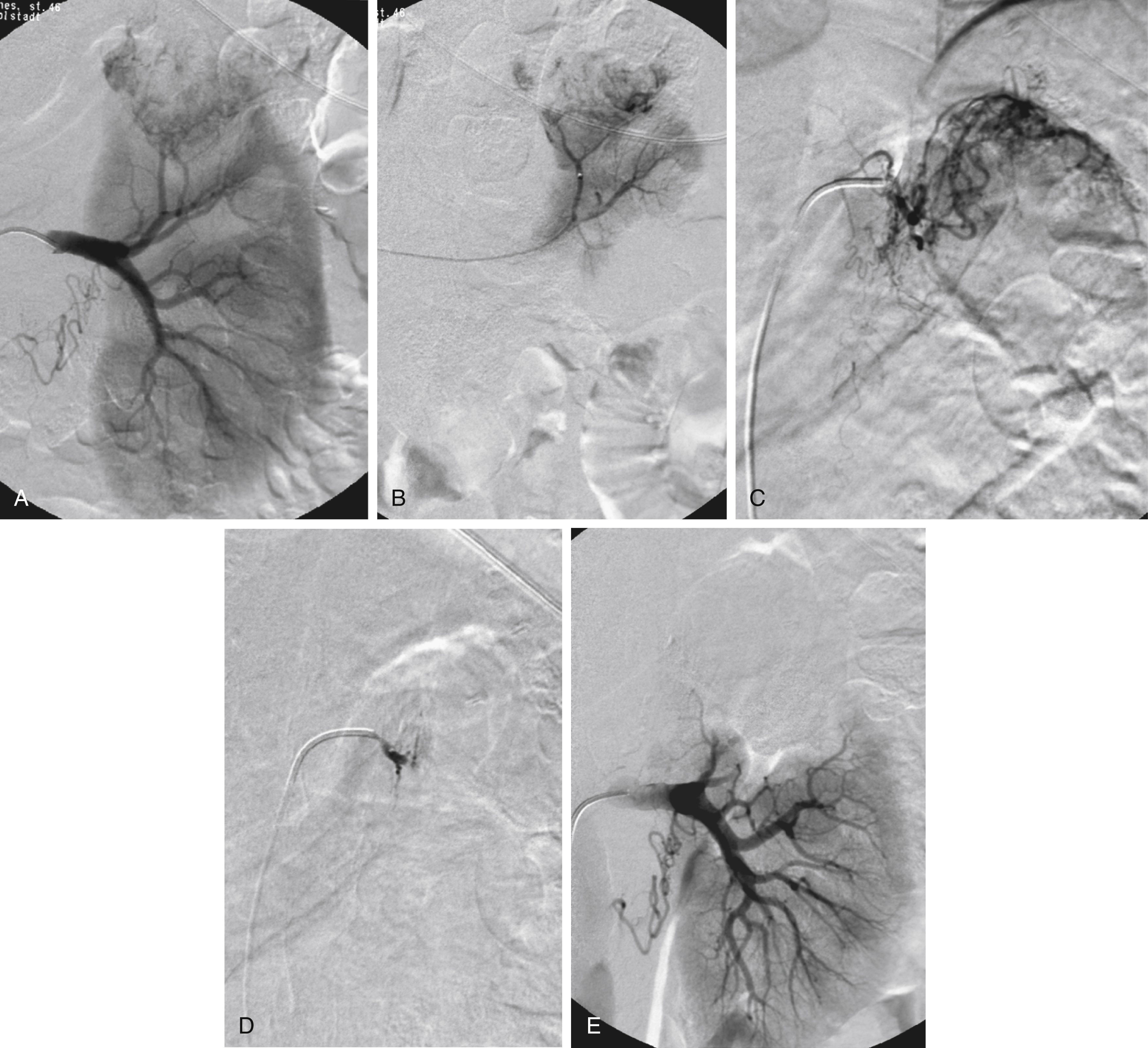 Fig. 32.1, Selective tumor embolization in a patient with a single kidney. (A) Angiography shows pathologic arteries at the upper pole, indicating a hypernephroma. (B) Superselective angiography of a tumor-feeding branch before particle embolization. (C) Selective angiography of the suprarenal renal artery shows additional tumor vascularization. (D) After particle embolization, this branch is completely excluded. (E) After embolization, the upper pole of the kidney is devascularized, but the lower pole renal parenchyma is preserved.