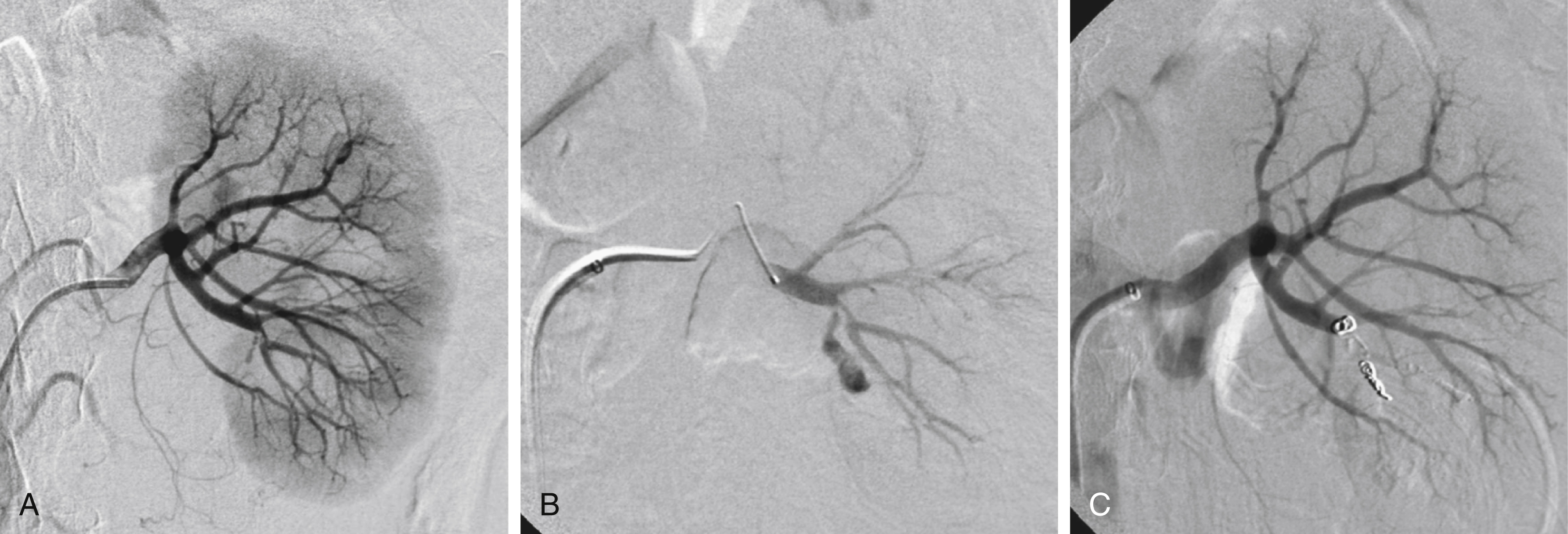 Fig. 32.2, Traumatic bleeding after nephrostomy. (A) A left renal angiogram shows narrowing of a lower pole branch and some extravasation. (B) Selective angiography clearly demonstrates extravasation. (C) After coil embolization combined with glue, sealing of the bleeding site has been achieved.