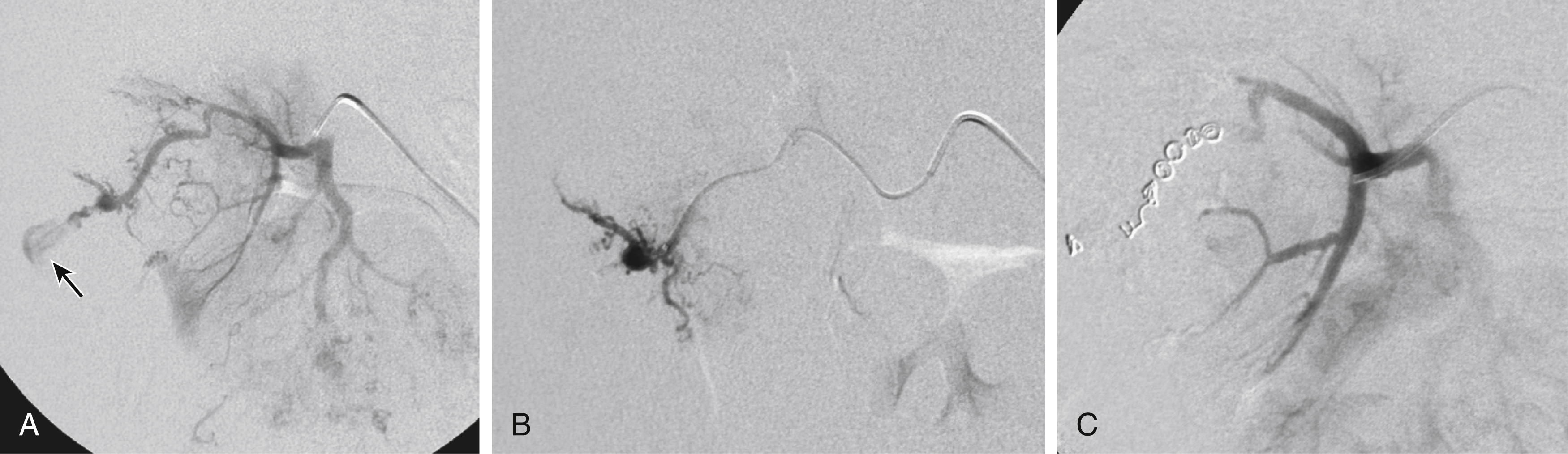 Fig. 32.3, Acute bleeding from a tumor (angiomyolipoma). (A) Right renal angiography shows irregular arteries, indicating an angiomyolipoma with free bleeding at the upper lateral portion ( arrow ). (B) The bleeding branch was selectively catheterized by a microcatheter. (C) After placement of several coils, the previously bleeding branch is interrupted and bleeding has stopped.