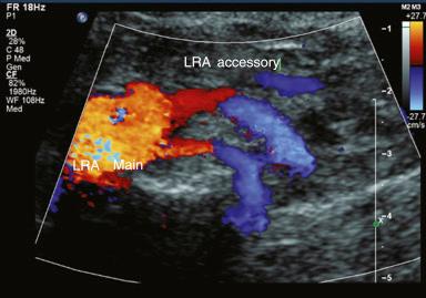 Fig. 42.1, Main and accessory left renal arteries (LRA) as defined on duplex ultrasound.