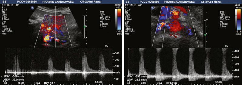 Fig. 42.2, (A and B) Bilateral renal artery stenosis of 60% to 99% on duplex ultrasonography in a 69-year-old woman.