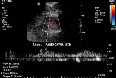 Fig. 42.3, Resistive index (RI) and prolonged acceleration time (≥100 ms) in a patient with 60% to 99% renal artery stenosis.