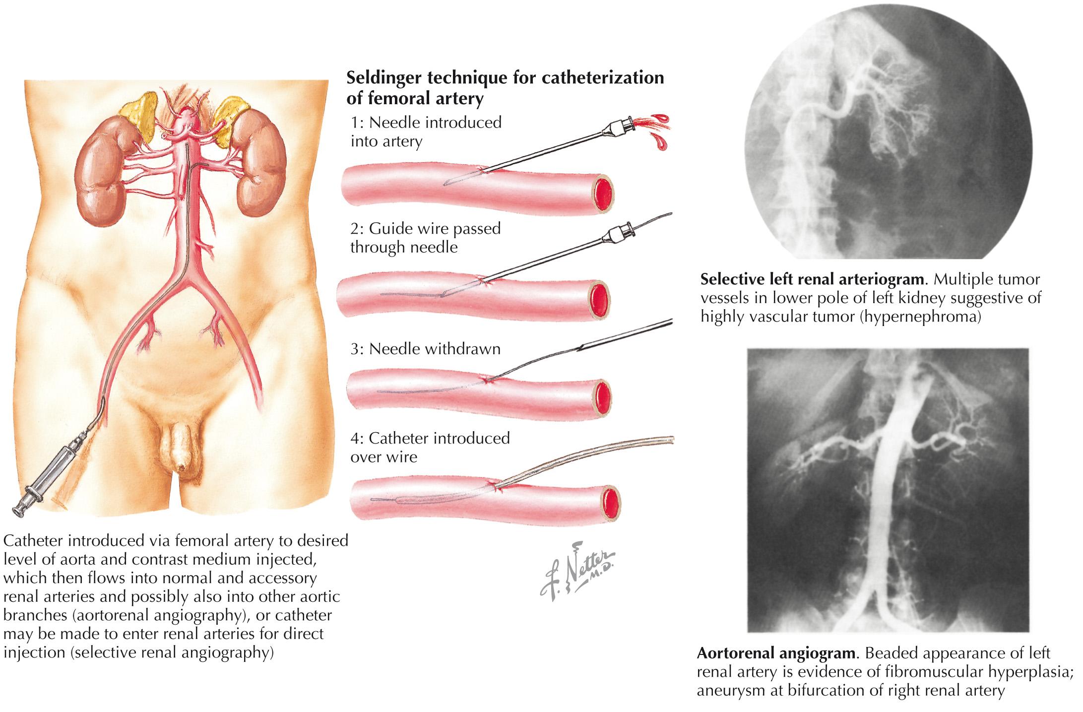 FIG 58.5, Aortorenal and Selective Renal Angiography (Transfemoral Approach).