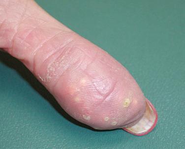 FIGURE 38-1, Calcinosis cutis: painful lesions on the distal fingertips of a patient with metastatic calcinosis cutis attributed to renal disease.