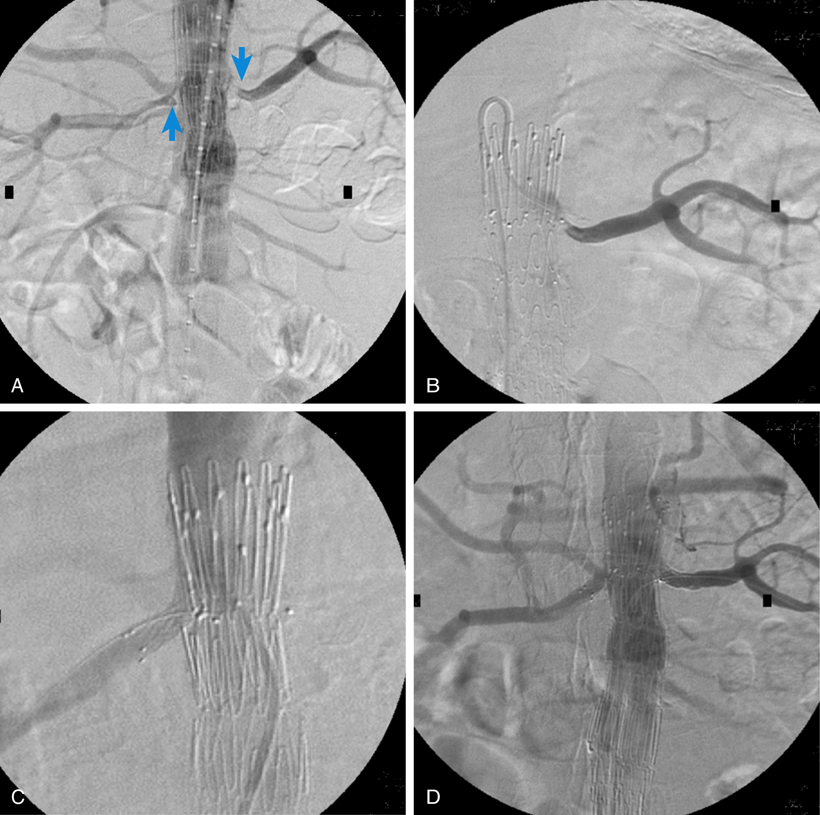 Fig. 31.1, Endovascular abdominal aneurysm repair with concomitant bilateral renal artery stenting due to flow impairment. (A) Final digital subtraction angiograph demonstrating flow impairment of both renal arteries ( arrows ). Immediate catheterization and stenting of the left (B) and subsequently the right (C) renal artery. (D) Final result demonstrating patency of both renal arteries.