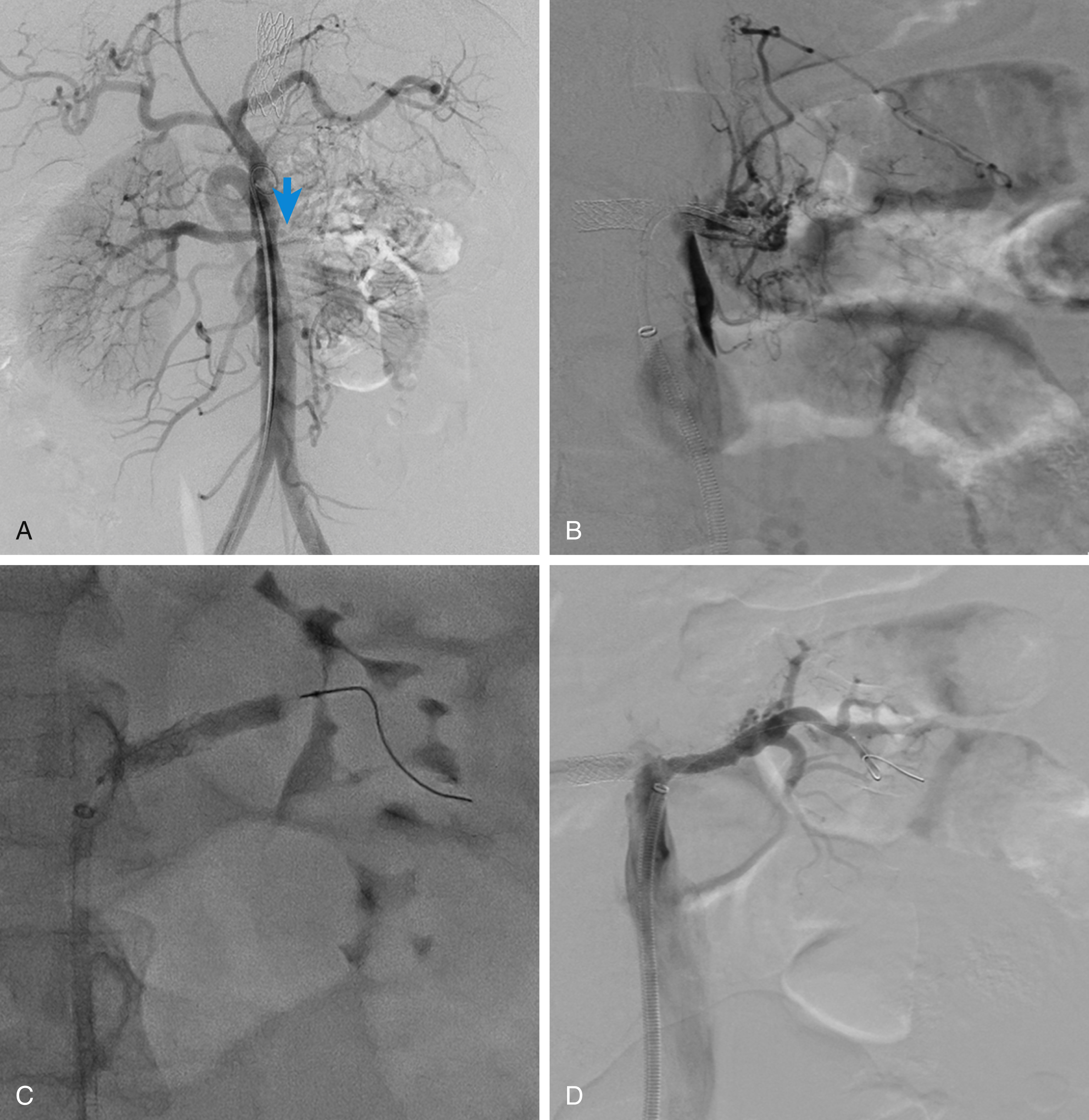 Fig. 31.2, A 20-year-old woman with previous bilateral renal artery and aortic stenting due to Takayasu arteritis. (A) Digital subtraction angiograph depicting occlusion of the left renal artery stent ( arrow ) confirmed after selective catheterization of the left renal artery (B). Note the collateral network supporting parenchymal perfusion. (C) Balloon angioplasty and (D) final result.