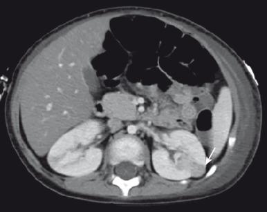 Figure 115.1, Solitary nephrogenic rest.