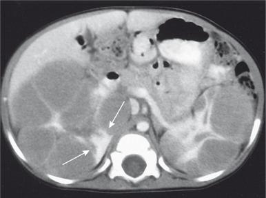 Figure 115.2, Diffuse perilobar nephroblastomatosis with symmetric involvement.