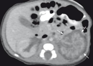 e-Figure 115.3, Asymmetric diffuse perilobar nephroblastomatosis.