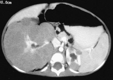 e-Figure 115.4, Diffuse perilobar nephroblastomatosis and right Wilms tumor.