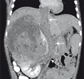Figure 115.6, Wilms tumor extending into the inferior vena cava and right atrium.
