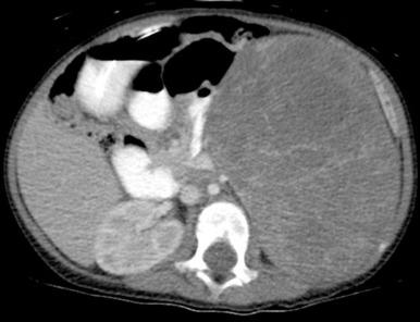 Figure 115.7, Wilms tumor.