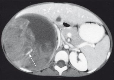 e-Figure 115.8, Wilms tumor containing calcification.