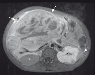 Figure 115.9, Bilateral Wilms tumor.