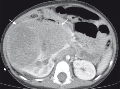 Figure 115.10, Clear cell sarcoma of the kidney.