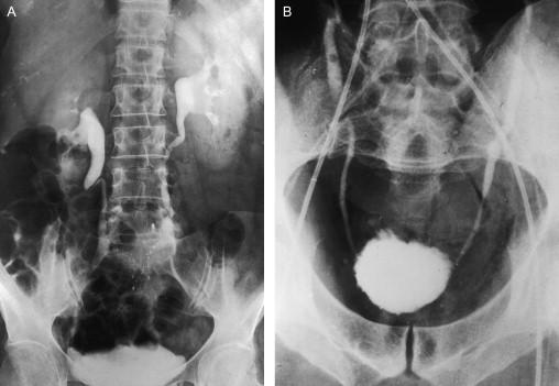 Figure 81.3, Intravenous pyelogram (A) demonstrating dilatation of the ureters during pregnancy. Note the sharp cutoff of the ureter at the pelvic brim where it crosses the iliac artery (the iliac sign). Postmortem injection studies (B) showing the relationships of the ureters and iliac arteries at the pelvic brim. The genesis of the iliac sign is shown on the right.