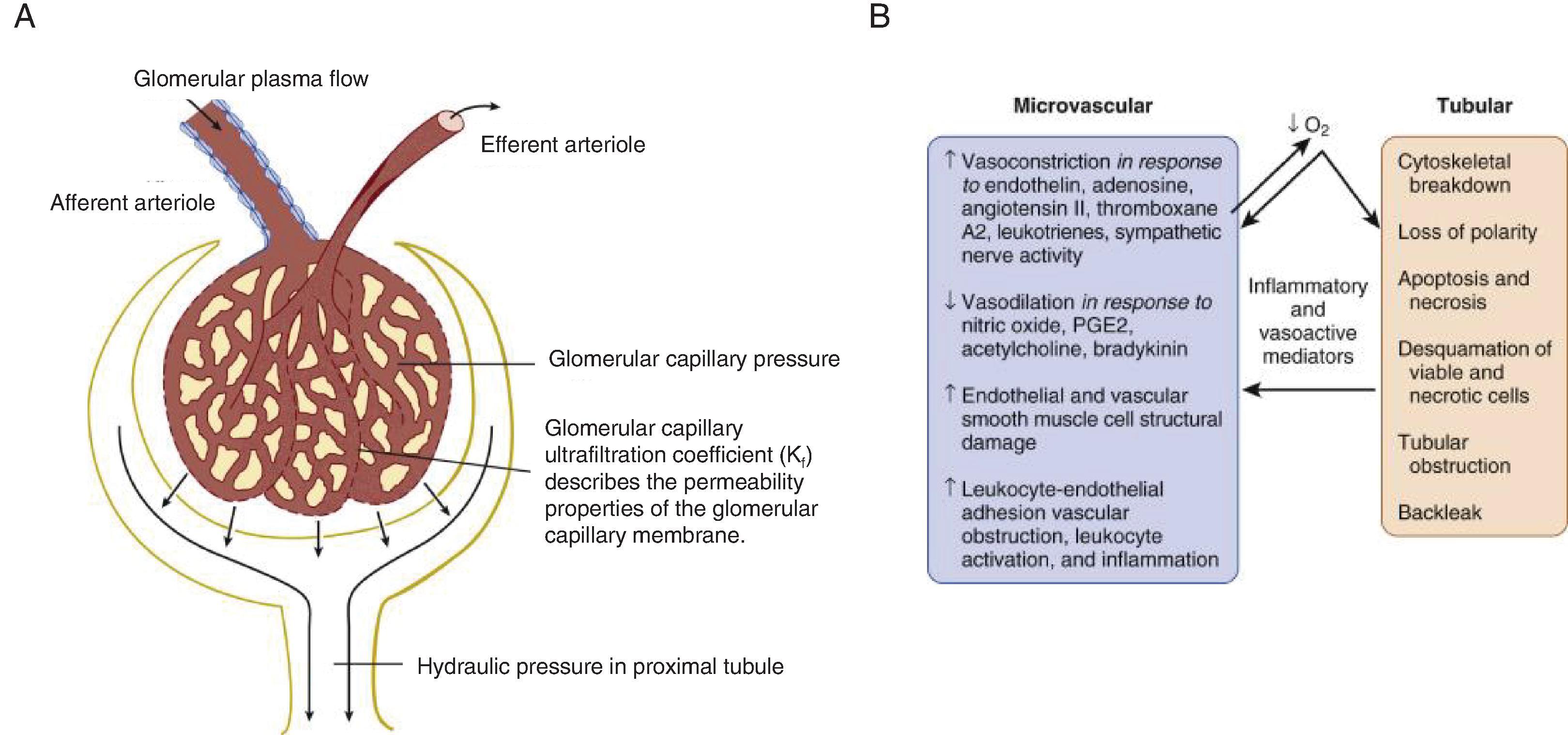 Fig. 59.1, (A) Glomerular filtration is determined by the rate of glomerular plasma flow (GPF) entering the afferent arteriole, the difference between the hydraulic pressure within the glomerular capillary and the hydraulic pressure in the proximal tubule, and the glomerular capillary ultrafiltration coefficient. (B) Pathophysiology of ischemic acute kidney injury. PGE2, Prostaglandin E 2 . (Figure modified and reproduced from Jetton et al. Pathophysiology of neonatal acute kidney injury. In Fetal and Neonatal Physiology , 165, 1668–1676.e3.)