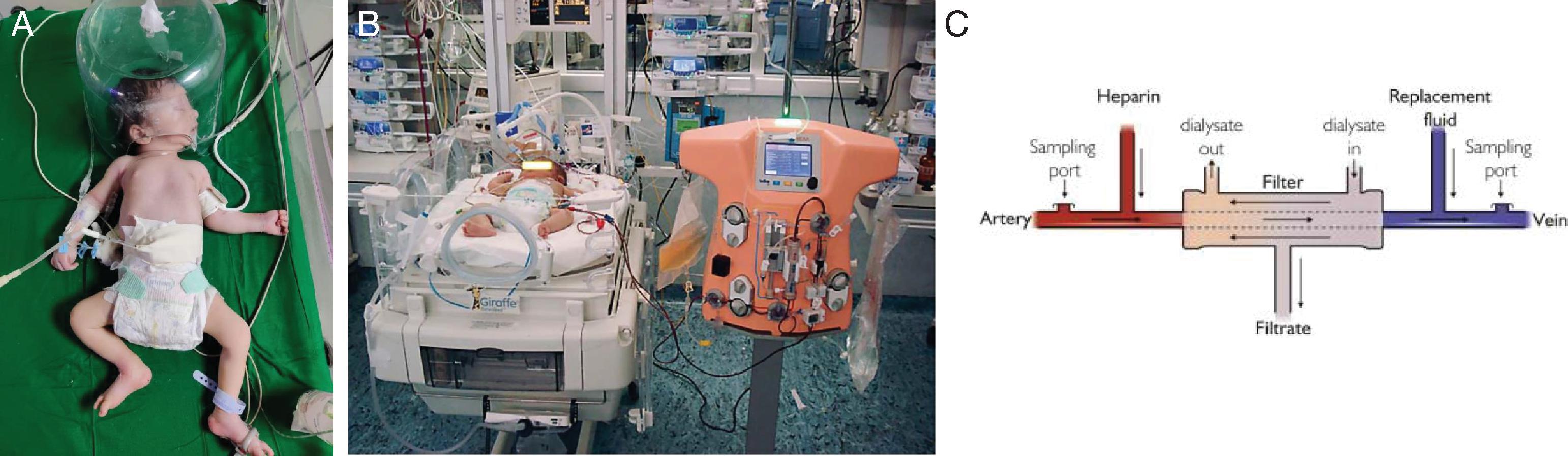 Fig. 59.2, Renal Replacement Therapies for Infants.