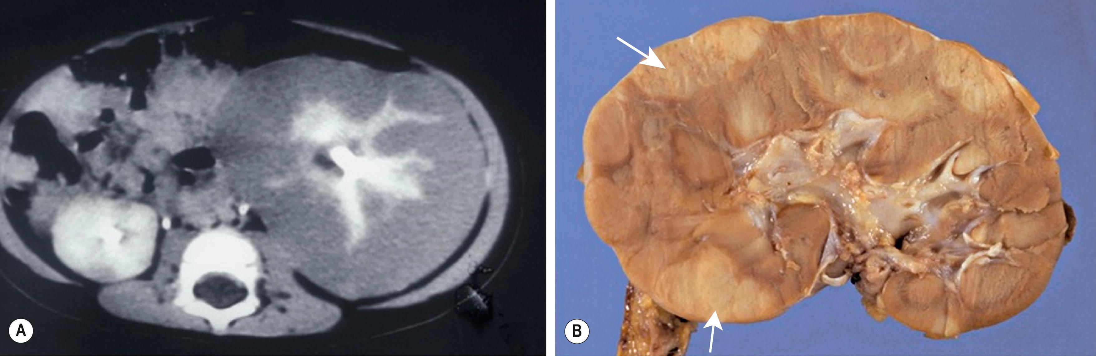 Fig. 64.3, (A) CT image of a 10-month-old infant who presented with a large left flank mass demonstrates a picture characteristic of diffuse hyperplastic perilobar nephroblastomatosis (DHPLN) with extensive involvement of the entire cortex of the kidney with no evidence of necrosis and general preservation of the shape of the kidney. (B) A resected kidney with a similar pattern of DHPLN reveals extensive involvement of the periphery of the cortex by severely hypertrophied nephrogenic rests (arrows). Resection of such kidneys should be avoided because, in most cases, the hypertrophy will resolve and the kidney will have excellent preservation of its function.