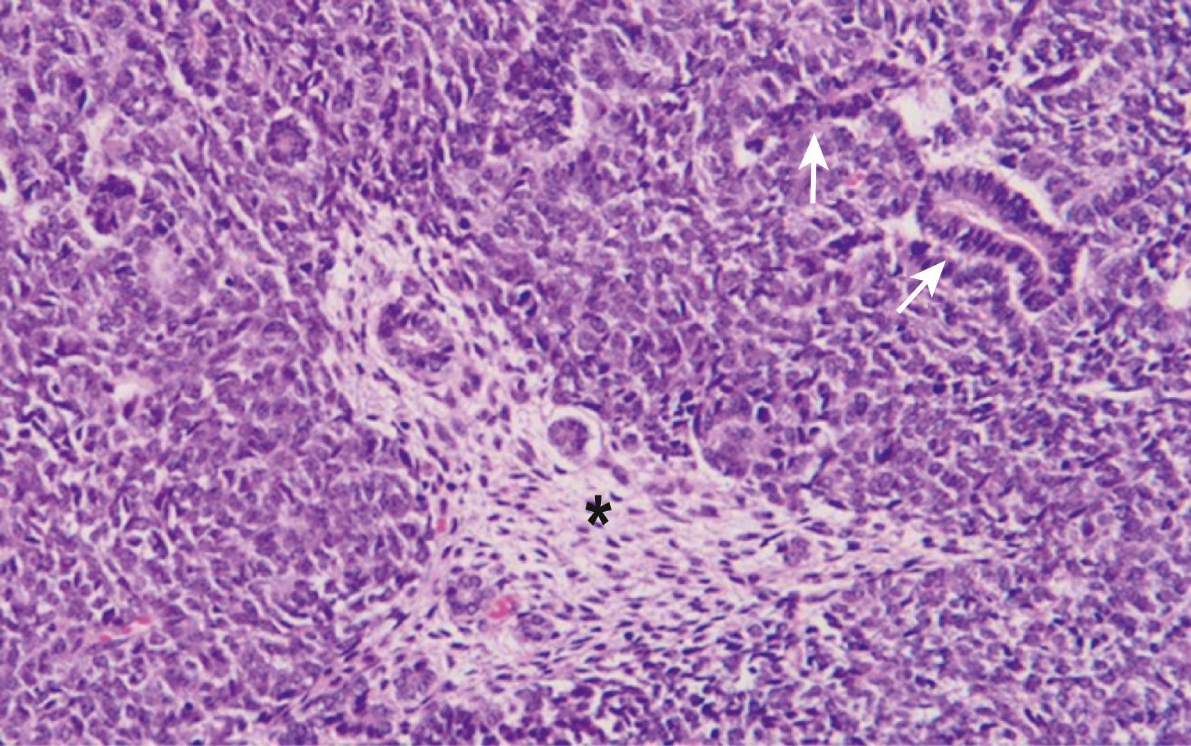 Fig. 64.4, The classic “triphasic” histologic pattern (blastemal, epithelial, and mesenchymal derivatives) of a Wilms tumor is seen on this H&E slide. There is a predominance of small undifferentiated blastemal cells in the image that surround a few neoplastic ducts and tubular epithelial structures (solid arrows). In the center is an island (asterisk) of spindle-shaped fibroblastic mesenchymal cells that surround a few tubules. The neoplastic cells in the image lack the requisite features of an anaplastic variant (see Fig. 64.5 ).