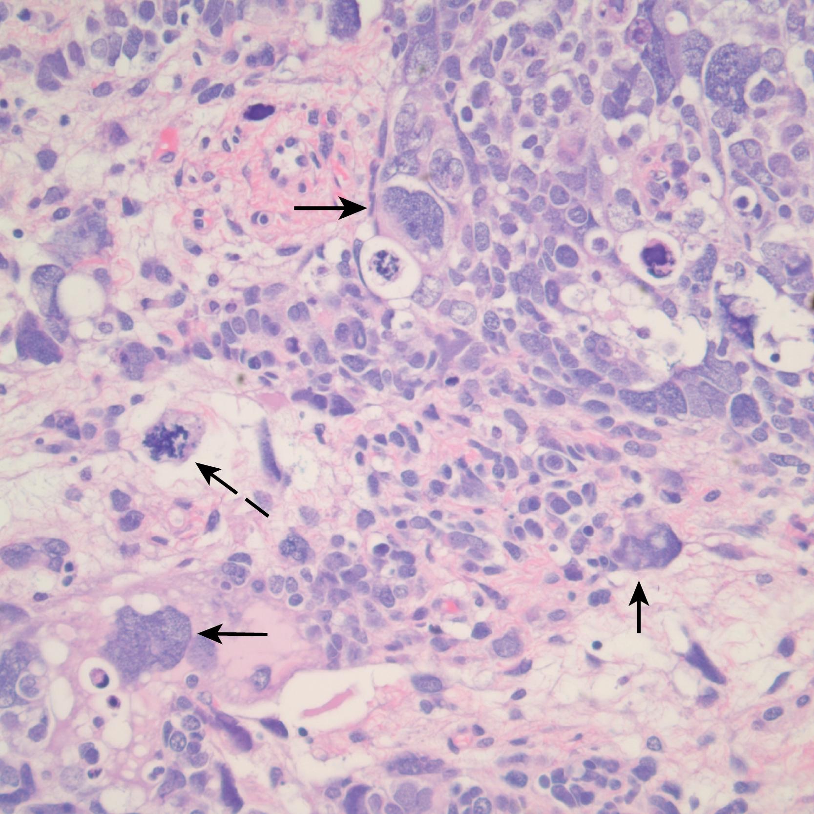 Fig. 64.5, Salient features of the anaplastic Wilms tumor variant with H&E staining. Anaplasia is defined by three requisite criteria that are all depicted in the image: atypical mitotic figures (dotted arrow) (often tripolar or multipolar), nuclear enlargement (solid arrows) to greater than three times the size of resident cell nuclei of the same type, and nuclear hyperchromicity present in some of the cells. Enlargement and hyperchromicity reflect the fact that anaplastic WTs contain nearly twice the amount of DNA as normal cells with duplication of many whole chromosomes in each cell.