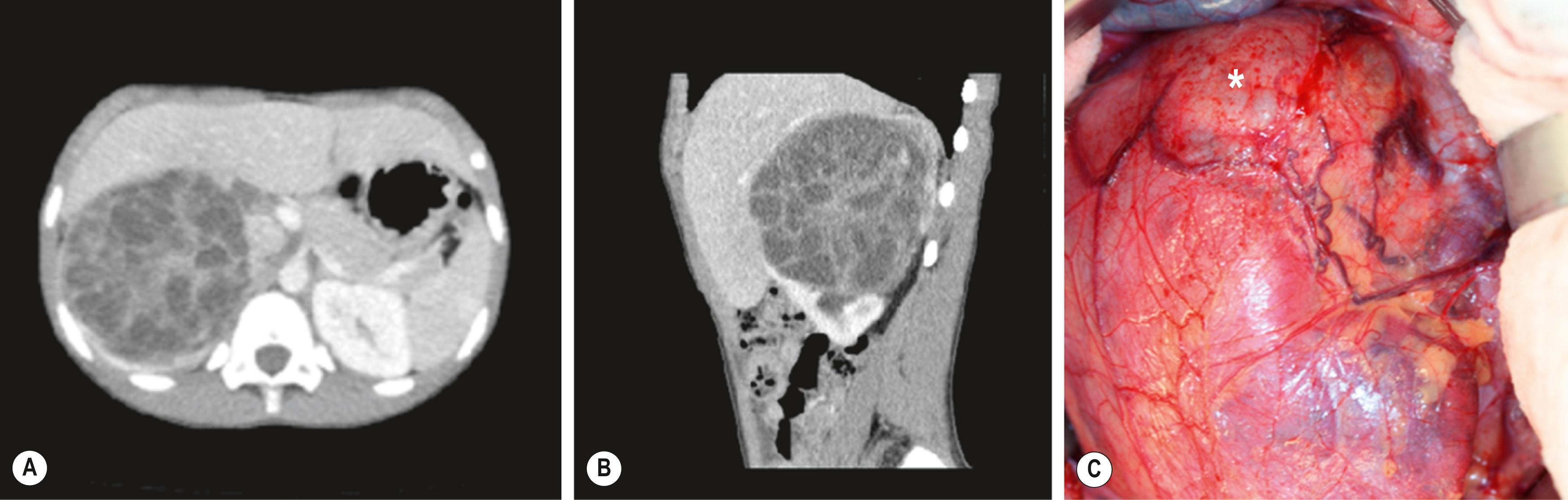 Fig. 64.6, Axial (A) and sagittal (B) CT images were taken in this 8-year-old patient with hematuria following an ultrasound that showed a large multicystic right renal mass measuring 12 × 8 × 7 cm. Further imaging studies did not show evidence of metastatic disease. He underwent uneventful right radical nephrectomy and node sampling. In the operative photograph (C) , the mass is seen arising from the upper pole of the right kidney (asterisk). The inferior vena cava is seen medial to the tumor. Histologic examination showed this tumor to be a clear cell sarcoma of the kidney. The lymph nodes were negative for tumor, and he has continued to recover uneventfully 4 years later without evidence of recurrent local or metastatic disease.