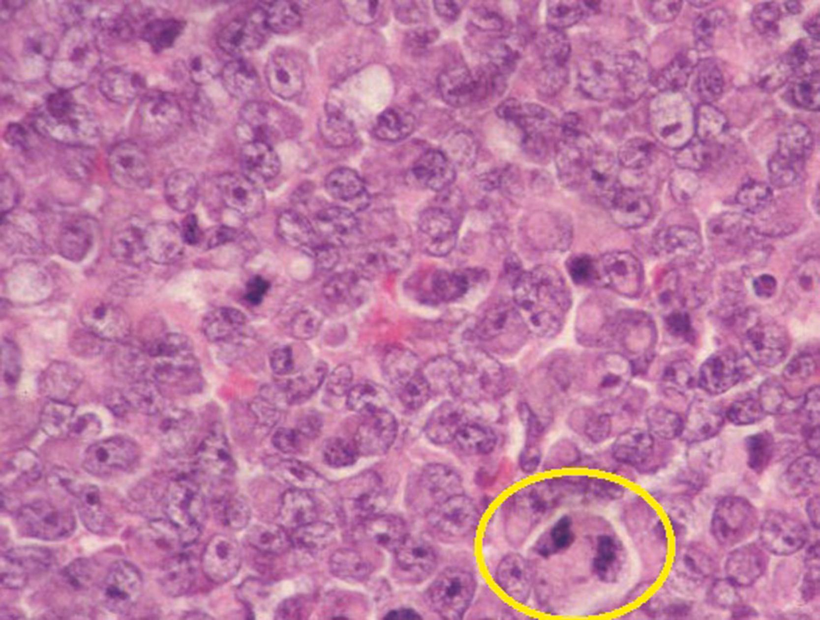 Fig. 64.7, High-power H&E slide of a rhabdoid tumor of the kidney. The yellow circle shows the classic periodic acid–Schiff–positive cytoplasmic inclusion “owl’s eyes” cells.