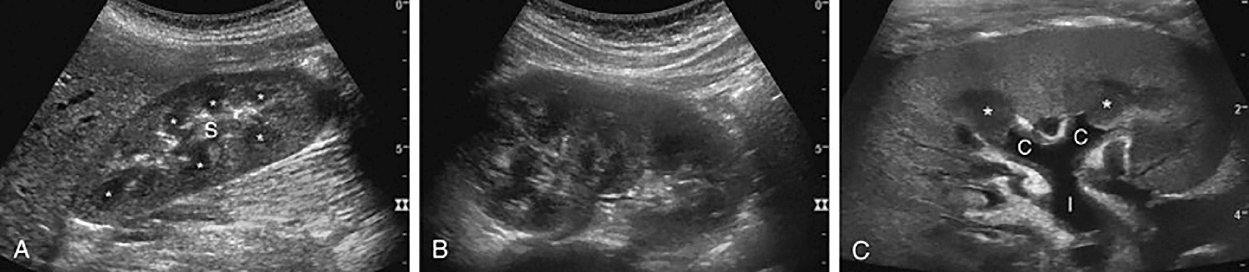 Fig. 50.1, (A–C) This is an ultrasound image of a normal kidney in the sagittal/longitudinal view. (A) The renal sinus (S) is echogenic (bright) and the renal pyramids (*) are hypoechoic (dark). (C) The renal calices (C) are clearly seen draining into the infundibulum (I) which is all part of the normal renal urinary drainage. 1