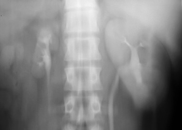 Figure 65-1, A 10-minute delayed image from an intravenous urogram shows a unilateral atrophic kidney on the right secondary to chronic renal insufficiency related to renal artery stenosis.