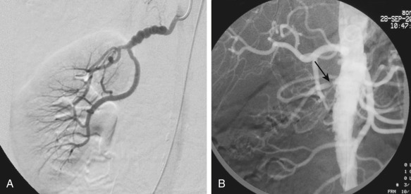 Figure 65-2, Digital subtraction angiography in two different patients. A, Beading of the renal artery consistent with fibromuscular dysplasia. B, Proximal severe right renal artery stenosis (arrow) secondary to atherosclerosis.