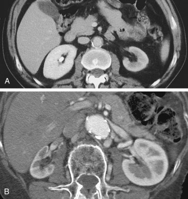 Figure 65-3, Contrast-enhanced computed tomography in two different patients with sequelae of renal artery stenosis. A, Delayed enhancement in a small left kidney. B, Atrophic right kidney. Note the atherosclerotic changes involving the aorta in both patients.