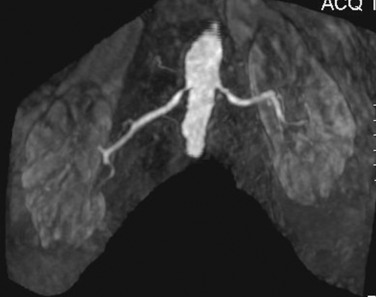 Figure 65-4, Three-dimensional magnetic resonance angiography of the renal arteries showing bilateral proximal renal artery stenosis. The stenosis is greater on the right.