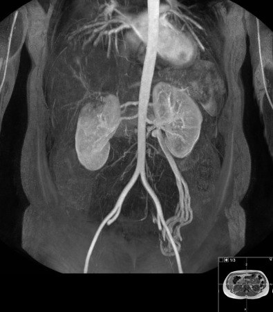 Figure 65-5, Three-dimensional balanced steady-state free precession noncontrast magnetic resonance angiography demonstrating normal renal arteries, two on the right and one on the left. Incidentally seen is a dilated tortuous left ovarian vein.