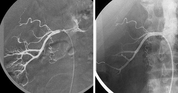 Figure 65-7, Percutaneous intervention in the same patient shown in Figure 65-4 demonstrating stent placement at the site of the proximal stenosis.