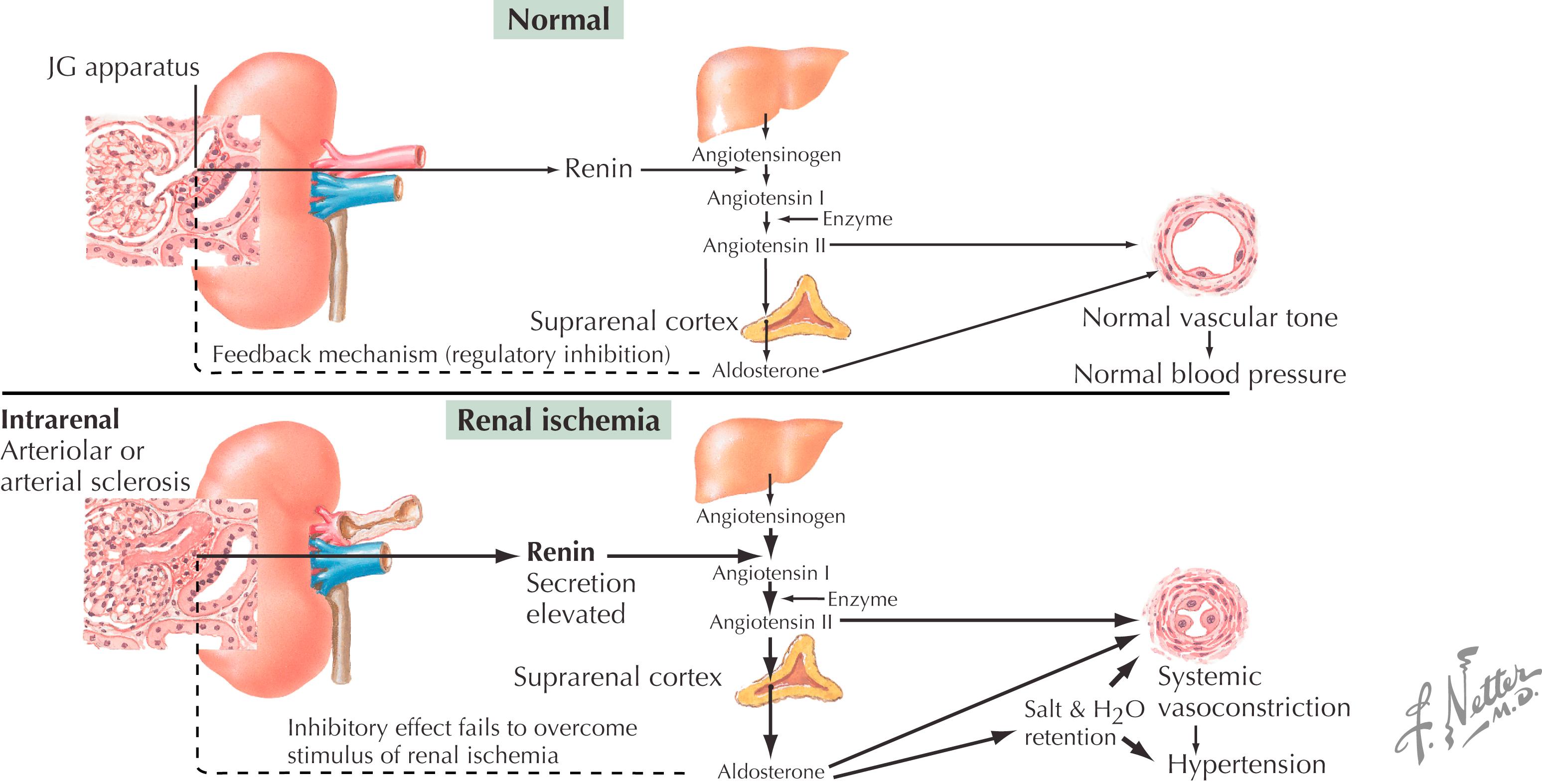 Figure 32.5, Renovascular hypertension.