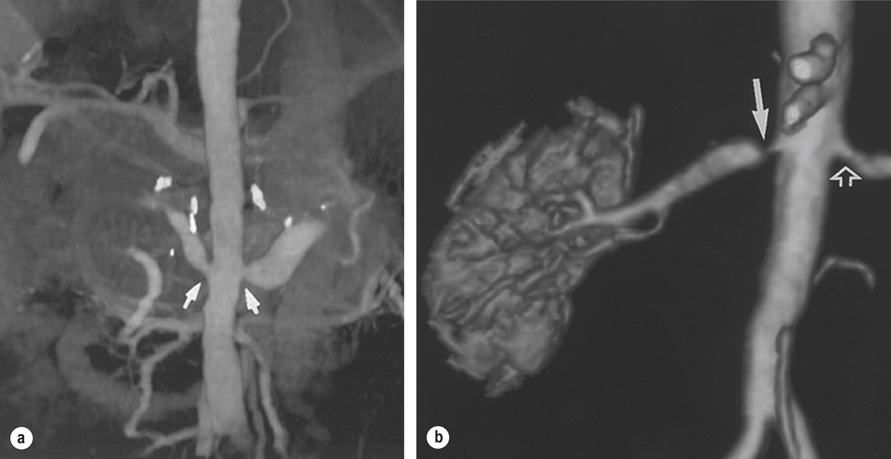 Figure 15.1, Bilateral renal artery stenosis. (a) Computed tomography; (b) Magnetic resonance angiography.