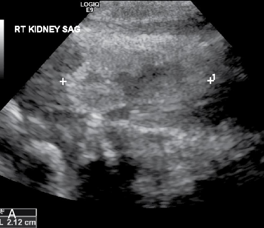 Fig. 18.1, Renal ( A and B ) and VCUG ( C ). A renal ultrasound shows small, mildly echogenic right kidney (2.12 cm) without hydronephrosis and a slightly larger mildly echogenic left kidney (2.62 cm) with dilatation of the left renal pelvis. VCUG demonstrates bilateral grade 3 vesicoureteral reflux.