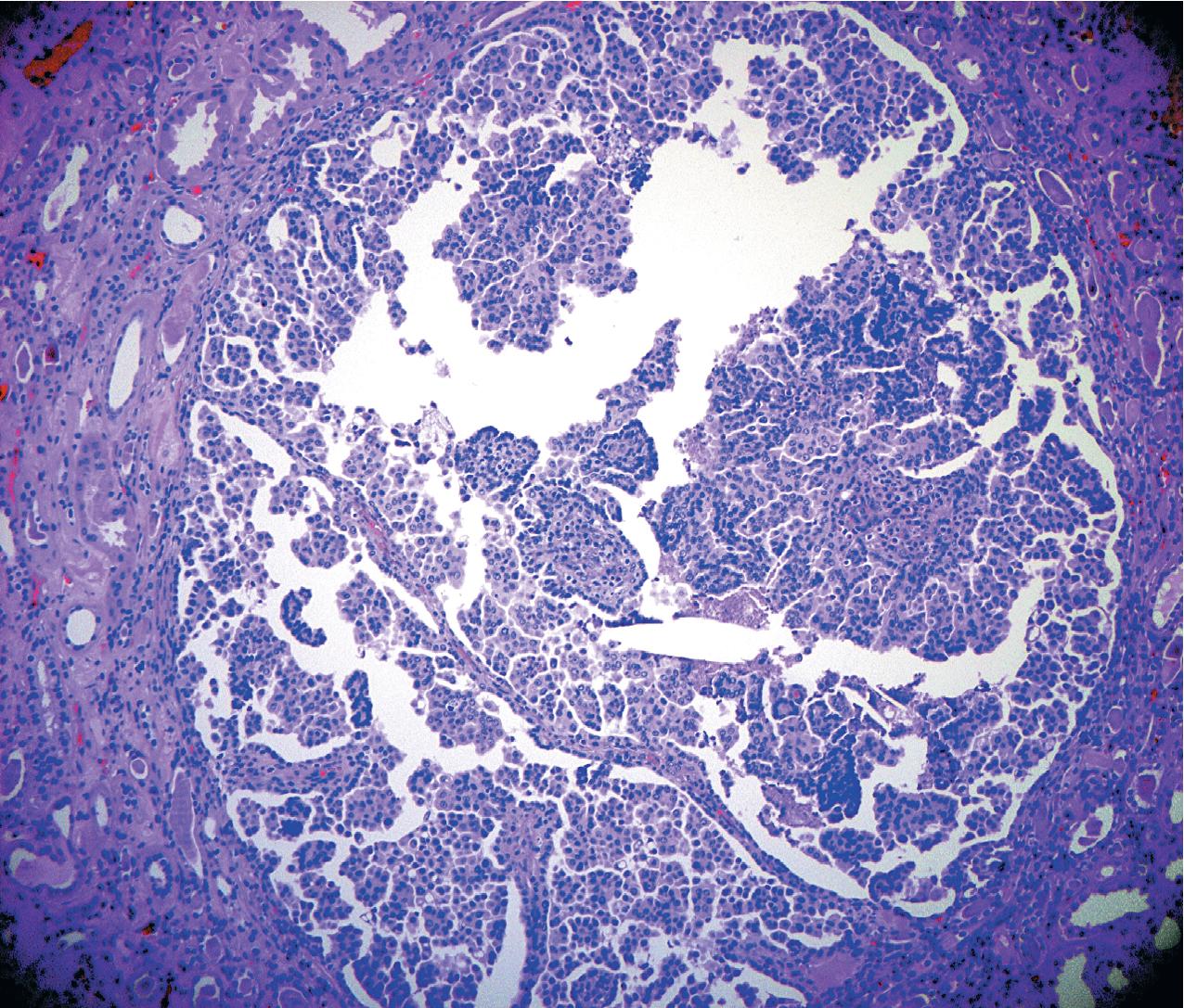 FIG. 10.1, Papillary tubular adenoma. The cells are arranged in a papillary pattern in this islet of tumor, which has eosinophilic cytoplasm and central nuclei. Adenomas may be precursors or part of a continuum of progression to malignancy (hematoxylin and eosin, ×100).