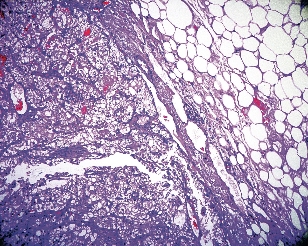 FIG. 10.11, Renal clear cell carcinoma. The periphery of the clear cell carcinoma demonstrates an invasion of the perinephric adipose tissue (hematoxylin and eosin, ×100).