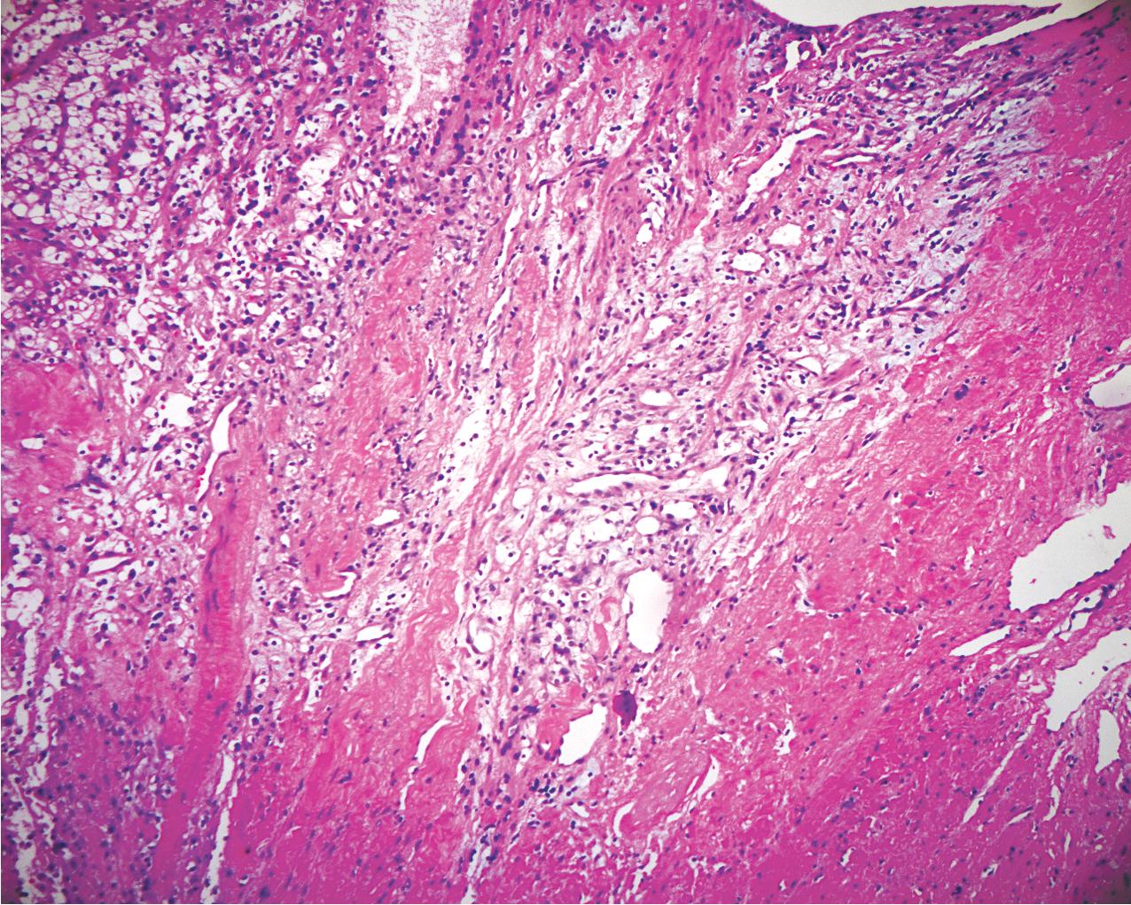 FIG. 10.12, Renal clear cell carcinoma. Invasion of the capsule is also evident with abundant vascular formation (hematoxylin and eosin, ×100).