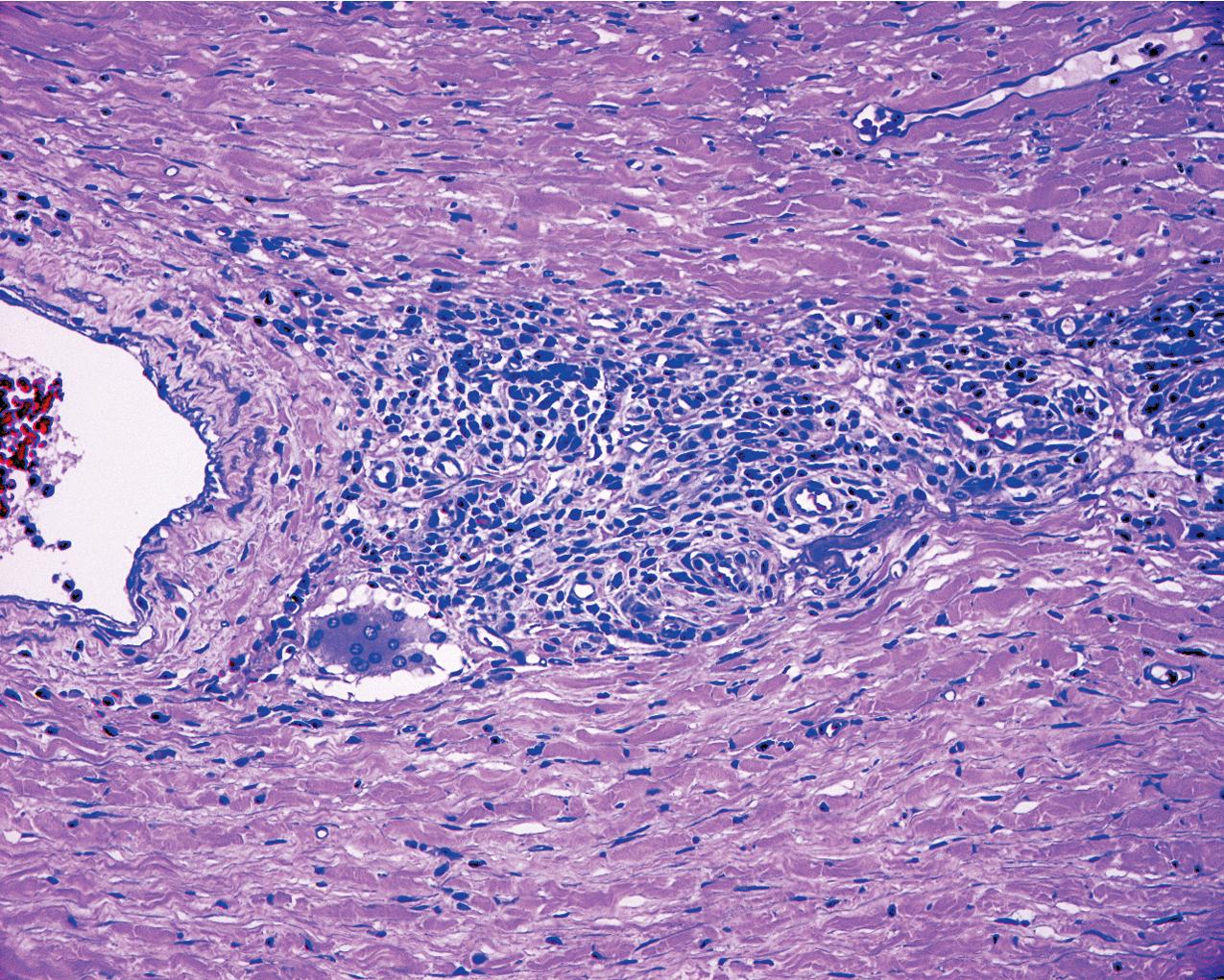 FIG. 10.13, Renal clear cell carcinoma. The invasive component sometimes has a sarcomatous appearance with elongated, fibroblast-like tumor cells with irregular hyperchromatic nuclei (hematoxylin and eosin, ×200).