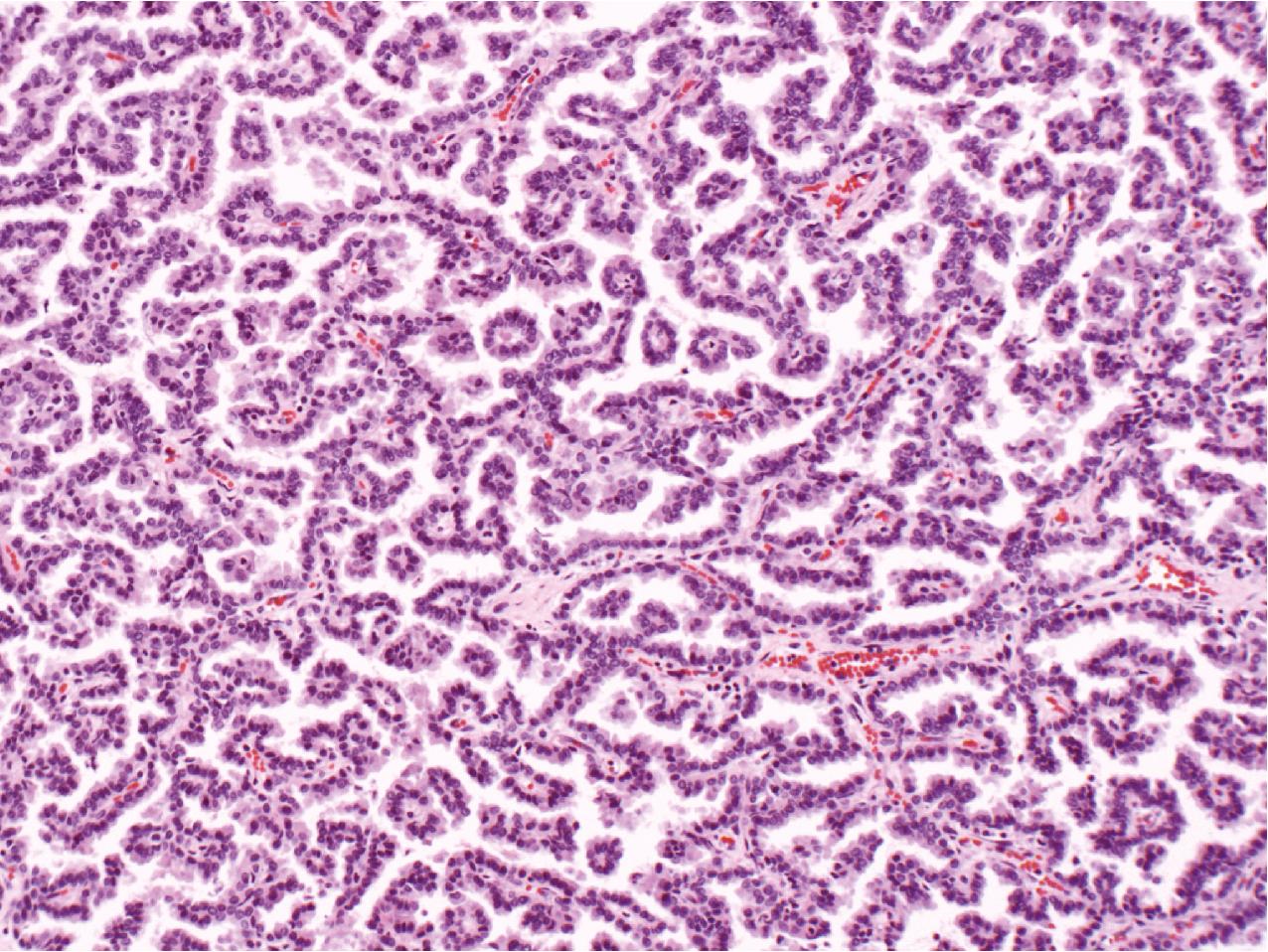 FIG. 10.14, Type 1 papillary renal cell carcinoma. The cells are arranged in a papillary pattern with scant eosinophilic cytoplasm and central nuclei arranged on a vascular core (hematoxylin and eosin, ×200).