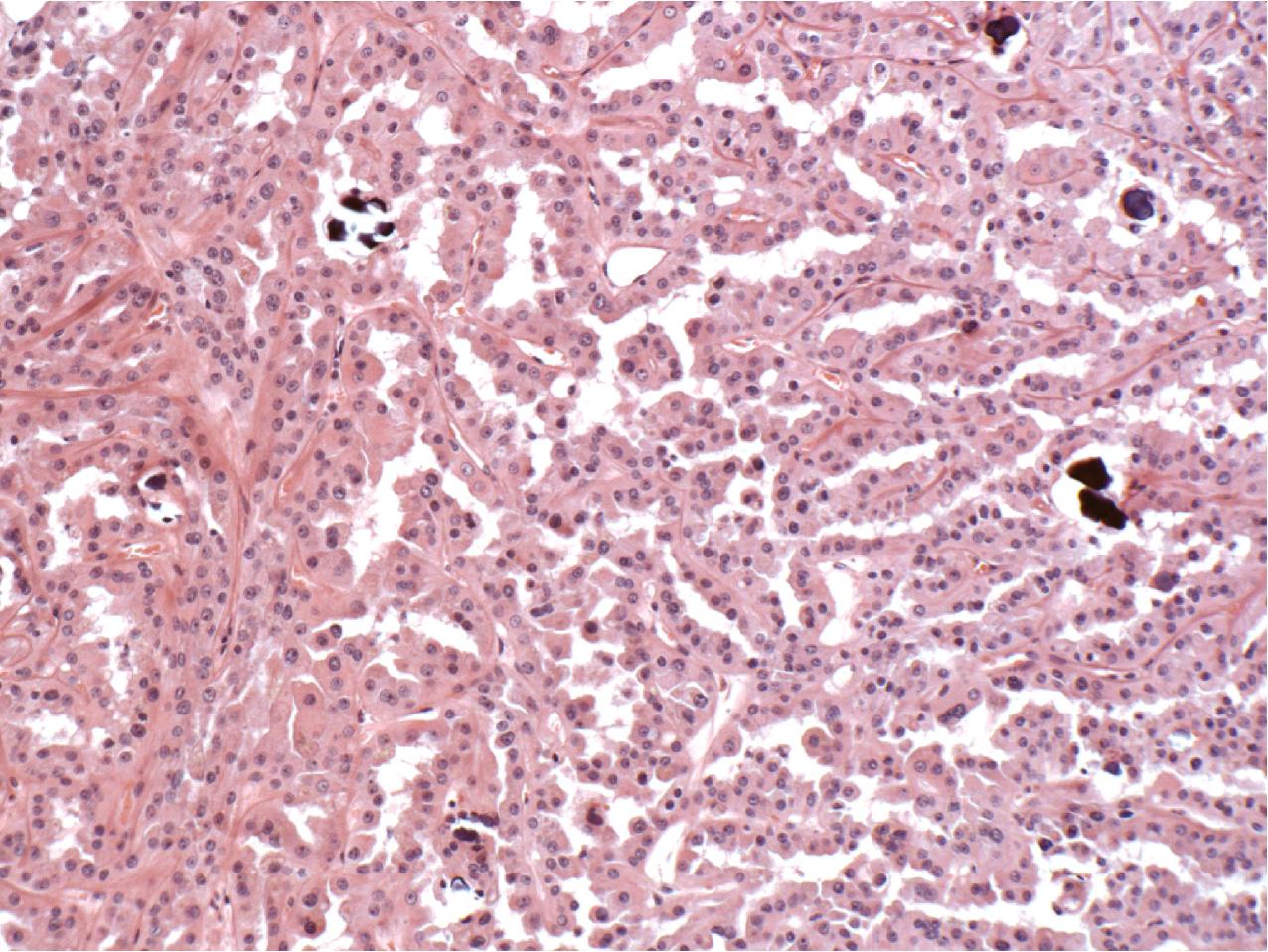 FIG. 10.15, Type 2 papillary renal cell carcinoma. There is an obvious papillary pattern on a central fibrovascular core with tall columnar cells with abundant eosinophilic cytoplasm. Focal calcifications are present (hematoxylin and eosin, ×200).