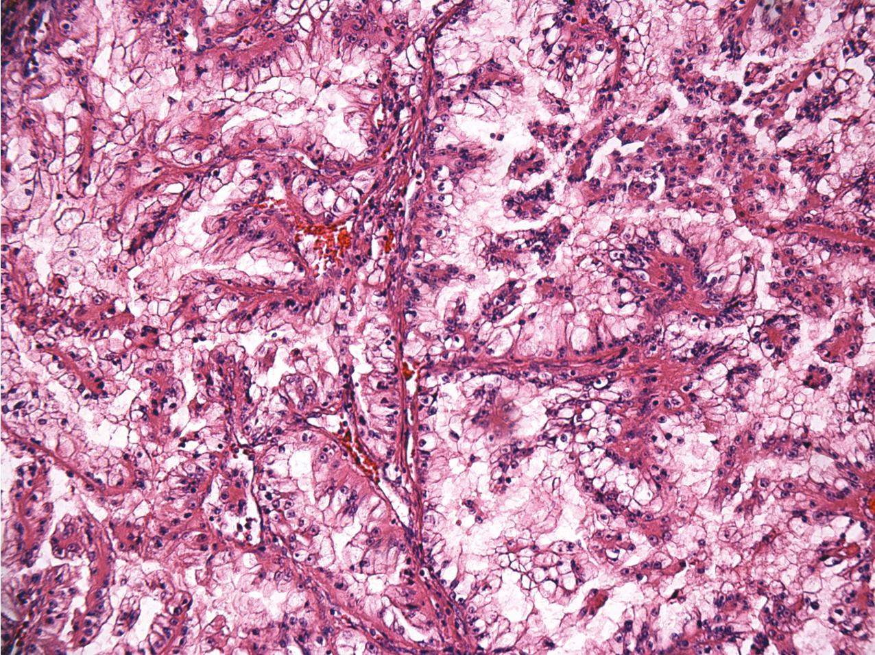 FIG. 10.16, Papillary microphthalmia-associated transcription (MiT) translocation renal cell carcinoma with a compact papillary pattern. The tumor cells contain basally located nuclei with voluminous clear cytoplasm (hematoxylin and eosin, ×200).