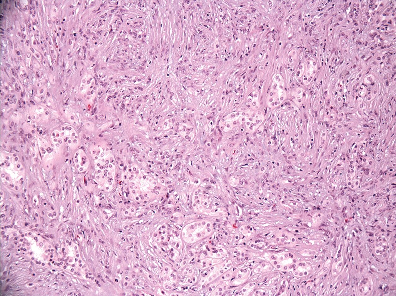 FIG. 10.17, Mucinous tubular and spindle cell renal cell carcinoma. Mucinous tubular epithelial cells are surrounded by aggregates of spindle cells (hematoxylin and eosin, ×400).